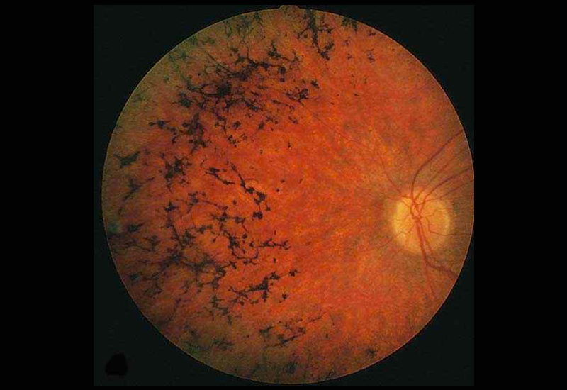 A Retinose Pigmentar: Um Olhar Detalhado Sobre a Realidade e a Ciência