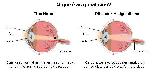 O que é Astigmatismo?