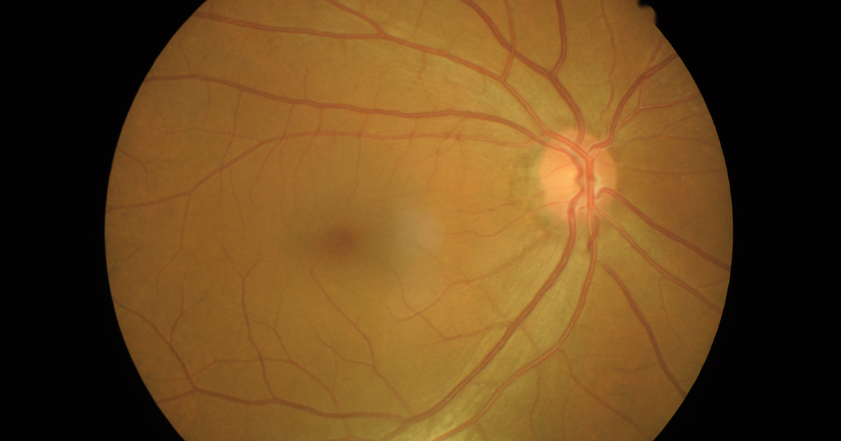 O que é descolamento da retina?