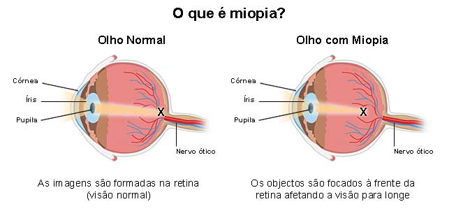 O que é a Miopia?
