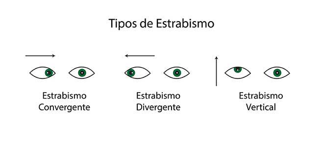 O QUE É ESTRABISMO?