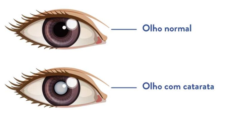 CATARATAS: O QUE SÃO E COMO TRATAR?