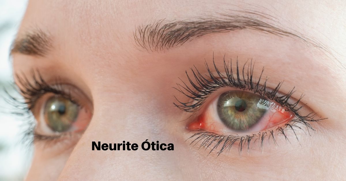 Neurite Ótica: O que é e como pode afetar a tua visão