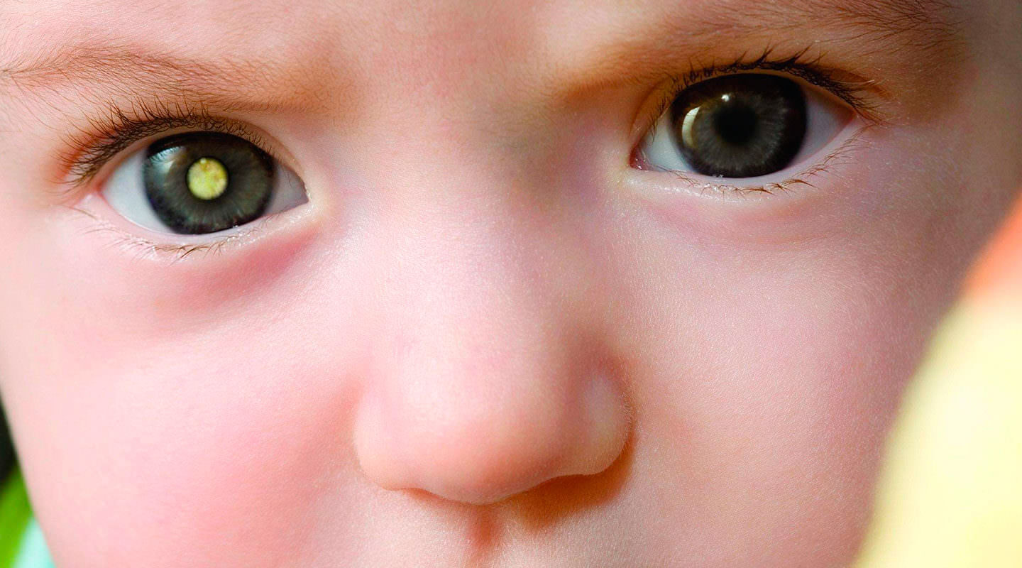 Tumores oculares, uma realidade ainda pouco conhecida!
